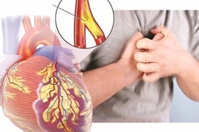 Nhận biết thiếu máu cơ tim ở người trẻ và cách phòng ngừa hiệu quả